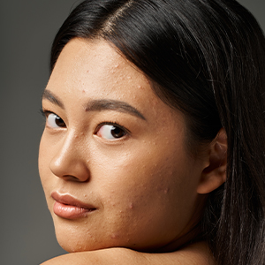 Shop for Acne Skincare Products - Woman with mild acne